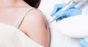 Factors That Impact The Tattoo Removal Process